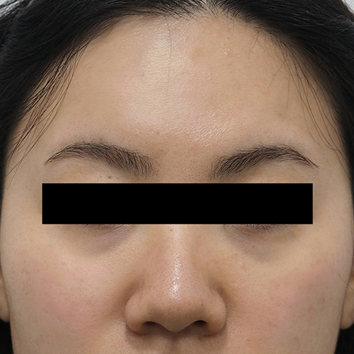 눈밑필러 Before