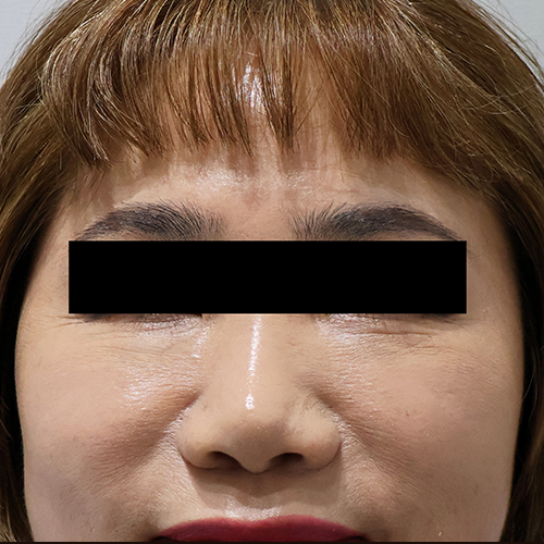 눈밑필러 After